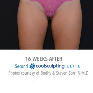 Inner-Thighs-Outer-Thighs-16-weeks