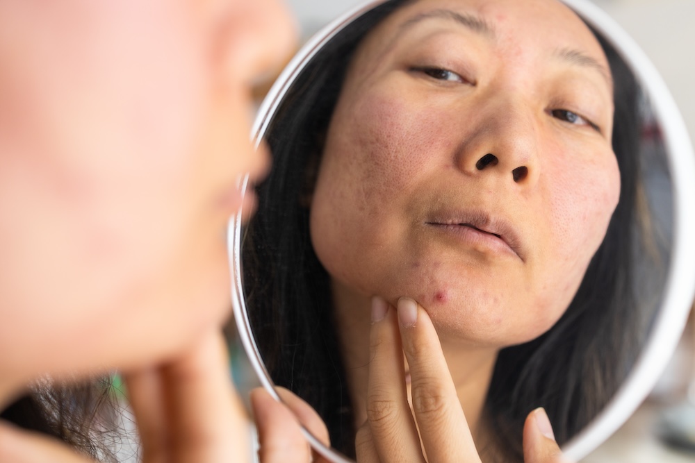 Woman examining zit on her chin in mirror, fighting the urge to pop it and deciding to go see a pimple specialist in Plano instead.