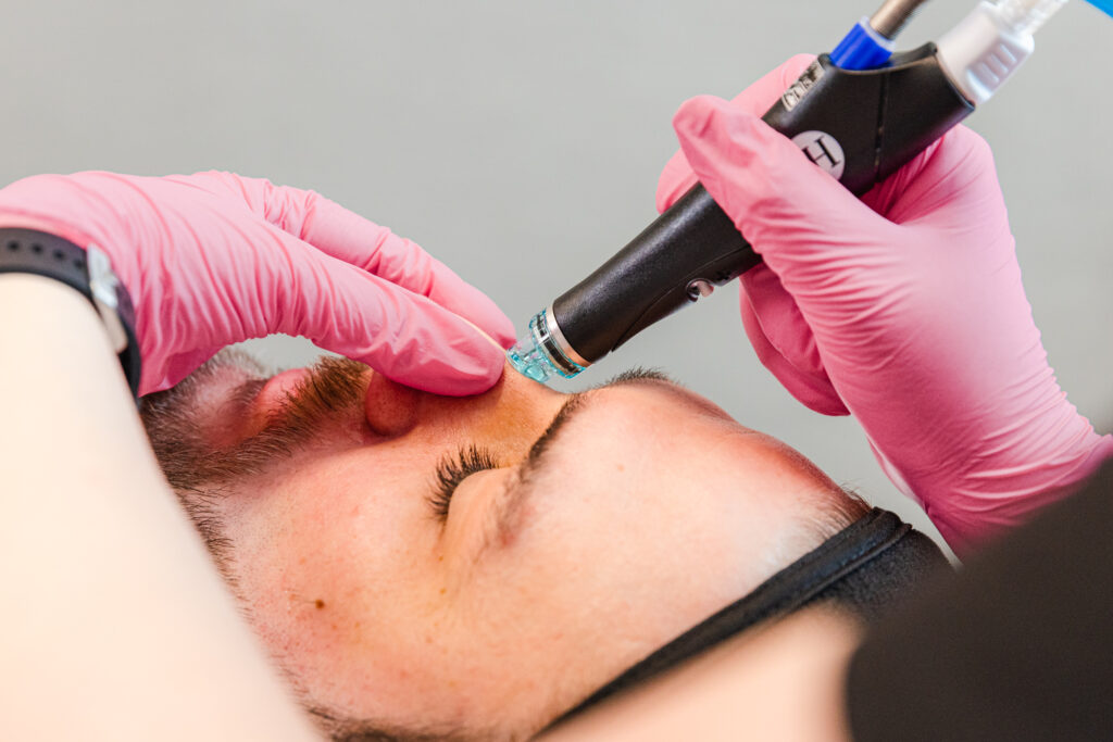 Provider wearing gloves holds patients nose with one hand and places the HydraFacial in Plano on his face with the other