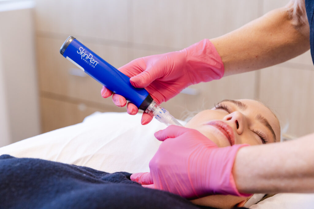 Woman lays on back with eyes closed as provider wearing gloves places a device for microneedling in Plano on her face.