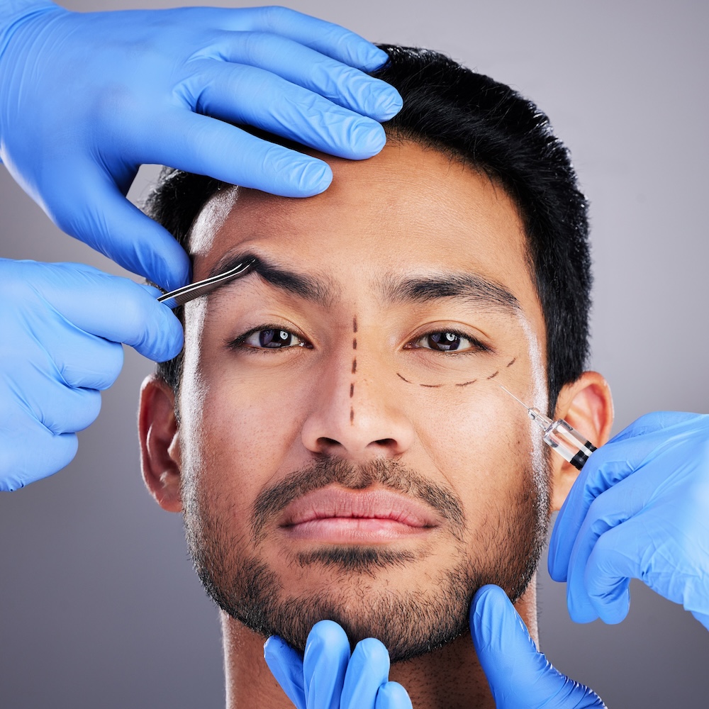 Man with lines indicating where incisions should be made as part of a brow and facelift at dermatology office that offers plastic surgery in Plano
