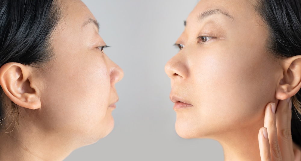 Two women look intently at one another, while one woman places her hand gently on her jawline and under her ear. They are assessing their options for double chin fat reduction in Plano.