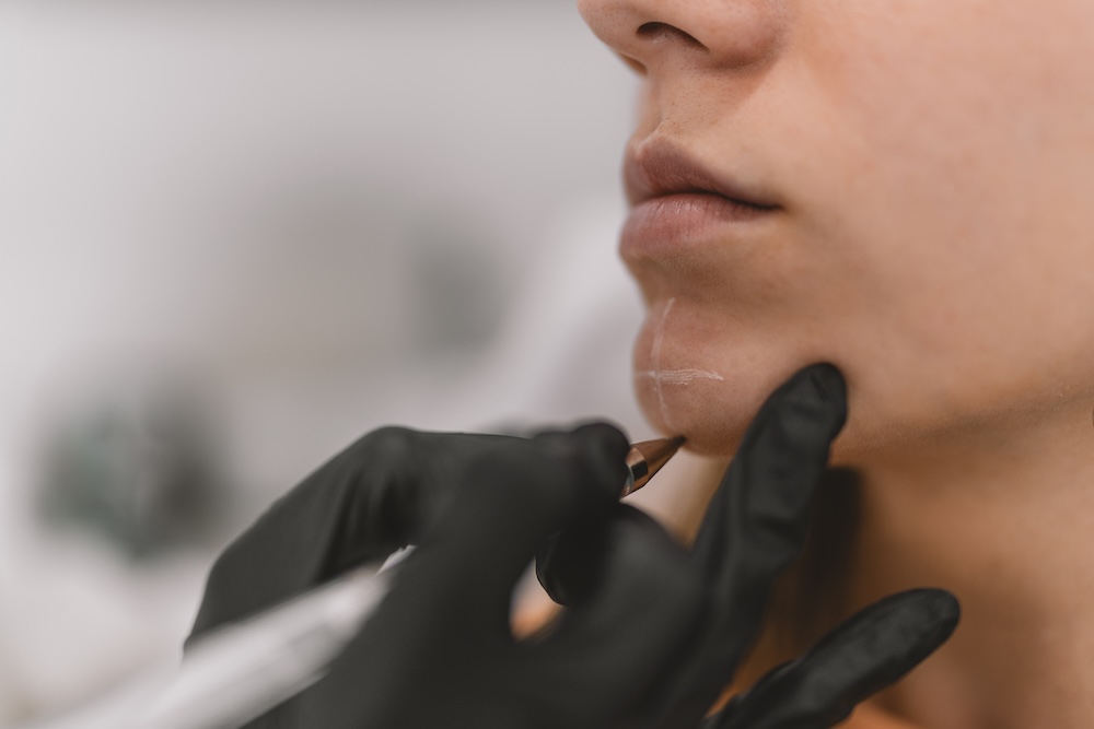 Close-up of medical professional wearing gloves drawing on patient's chin to indicate where to inject to augment their jawline for chin filler near Frisco.