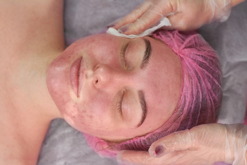 Woman lays on her back with eyes closed and hair protected by a wrap while a rosacea dermatologist in Frisco places their hands on her cheeks during a treatment process