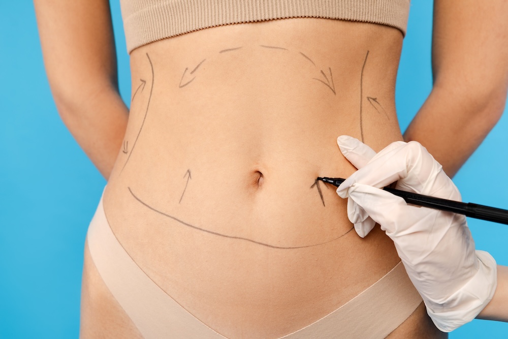 woman's stomach with arrows and lines across it, indicating where incisions will be made for her tummy tuck in Plano.