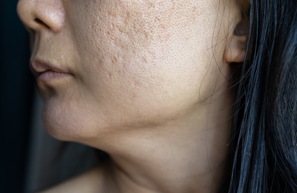 Side profile of woman with acne scars, a result from her pimple treatment in Plano.