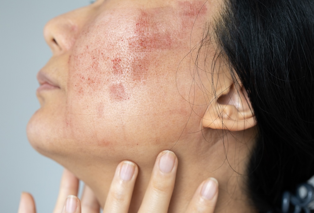 Patient with red marks on the side of her face. It's hard to identify if this is a rash or another skin condition. This highlights the importance of visiting a dermatologist in Richardson for a skin check.