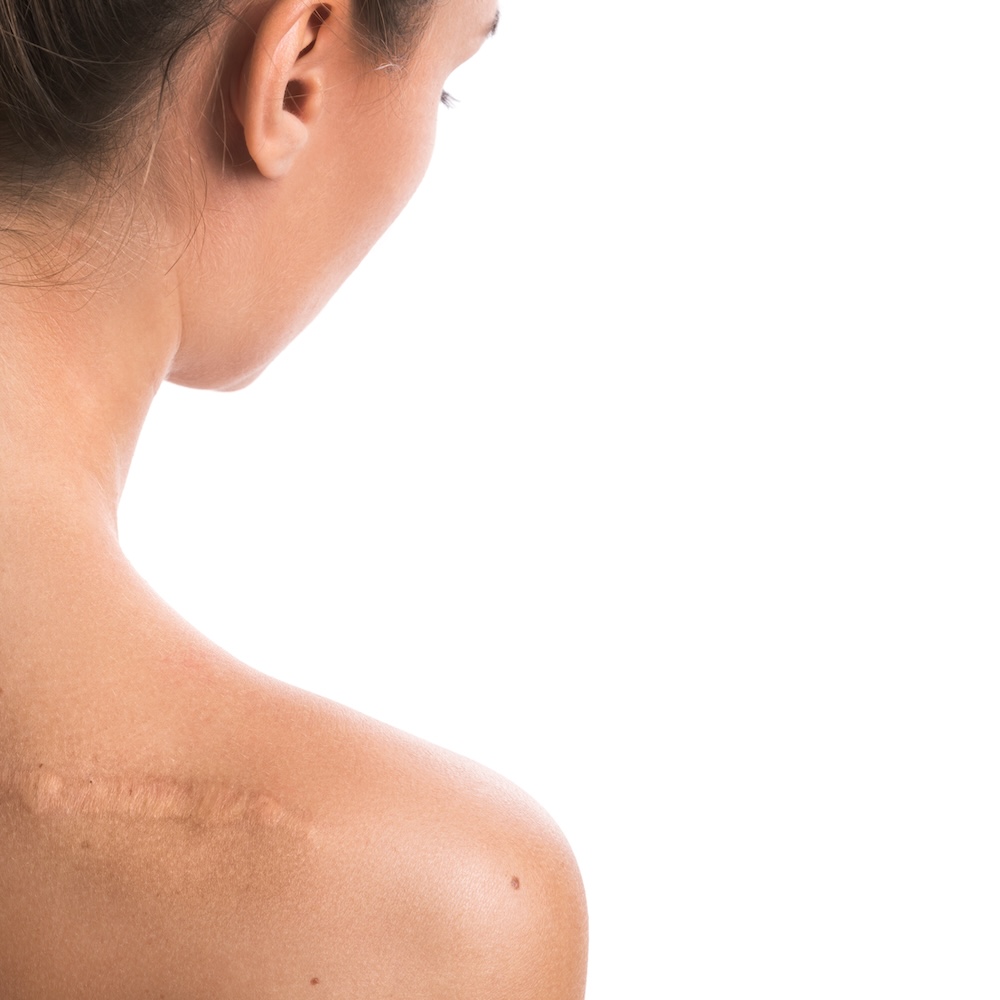 Woman with back turned to camera, revealing a scar on her shoulder. She is considering options for scar revision in Prosper